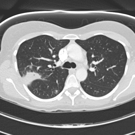 File:Necrobiotic pulmonary nodules - Crohn disease (Radiopaedia 20723-20631 Axial lung window 50).jpg