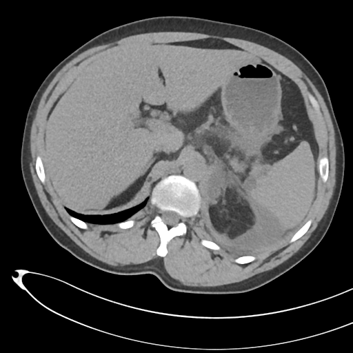 File:Necrotizing pancreatitis with acute necrotic collections (Radiopaedia 38829-41012 Axial non-contrast 23).png