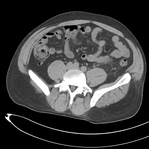 File:Necrotizing pancreatitis with acute necrotic collections (Radiopaedia 38829-41012 Axial non-contrast 54).png