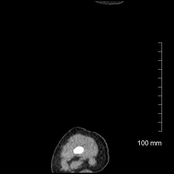 File:Neonatal neuroblastoma (Radiopaedia 56651-63438 C 6).jpg