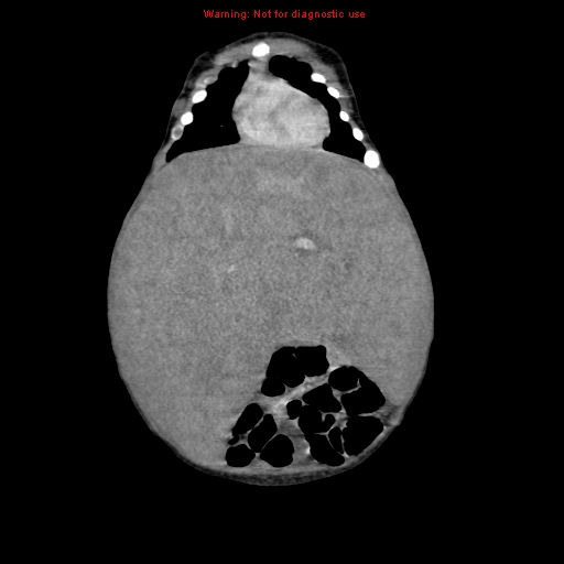 File:Neonatal neuroblastoma (Radiopaedia 9564-10223 B 41).jpg