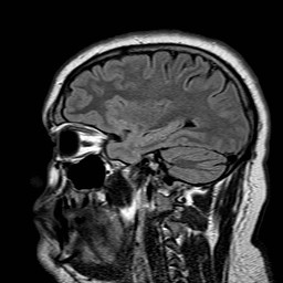 File:Neuro-Behcet's disease (Radiopaedia 21557-21506 Sagittal FLAIR 25).jpg