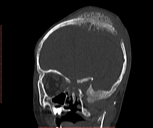 File:Neuroblastoma skull metastasis (Radiopaedia 56053-62683 Coronal bone window 12).jpg