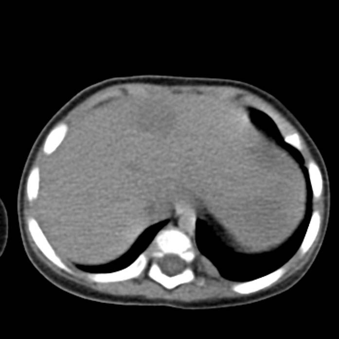 Neuroblastoma with skull metastases (Radiopaedia 30326-30960 Axial non-contrast 7).jpg