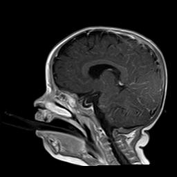 File:Neurofibromatosis type 1 (Radiopaedia 30089-30671 Sagittal T1 C+ 10).jpg