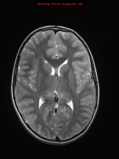 File:Neurofibromatosis type 1 with optic nerve glioma (Radiopaedia 16288-15965 Axial T2 12).jpg