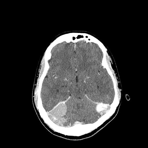 File:Neurofibromatosis type 2 (Radiopaedia 25389-25637 Axial C+ 32).jpg
