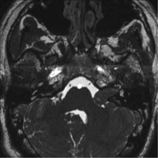 Neurofibromatosis type 2 (Radiopaedia 44936-48838 E 23).png