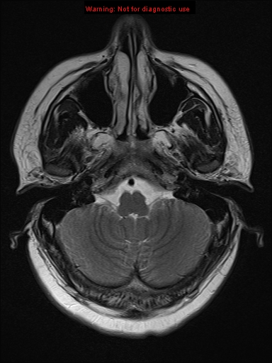 File:Neuroglial cyst (Radiopaedia 10713-11184 Axial T2 19).jpg