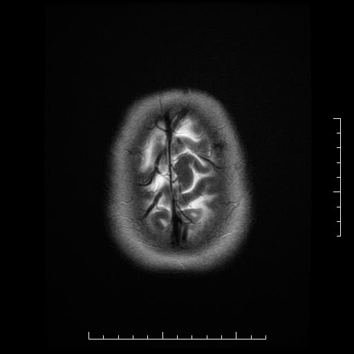 File:Neuroglial cyst of brainstem (Radiopaedia 29134-29526 Axial T2 20).jpg