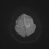 File:Neurotoxoplasmosis - concentric target sign (Radiopaedia 70644-80784 Axial DWI 20).jpg