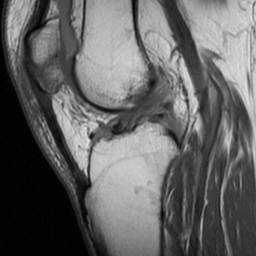 File:Non-displaced patella fracture (Radiopaedia 15932-15582 Sagittal T1 11).jpg