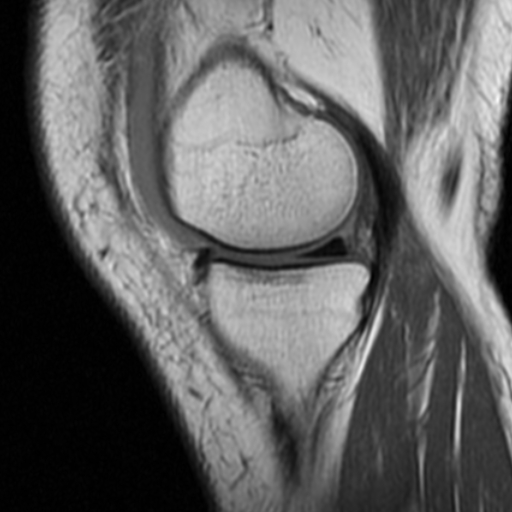 File:Non-displaced patella fracture (Radiopaedia 15932-15582 Sagittal T1 5).jpg
