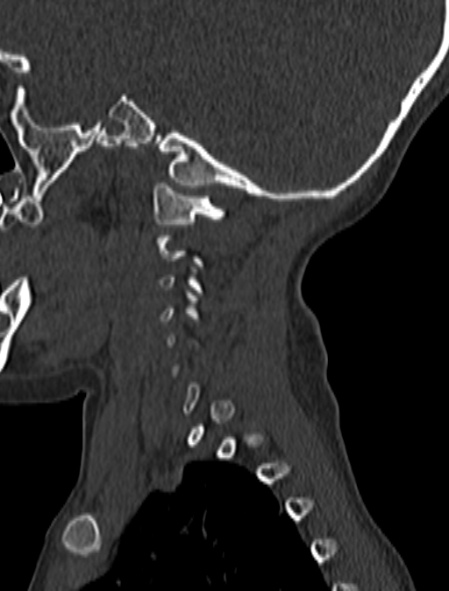 Normal CT cervical spine - pediatric (Radiopaedia 52549-58462 Sagittal bone window 187).jpg