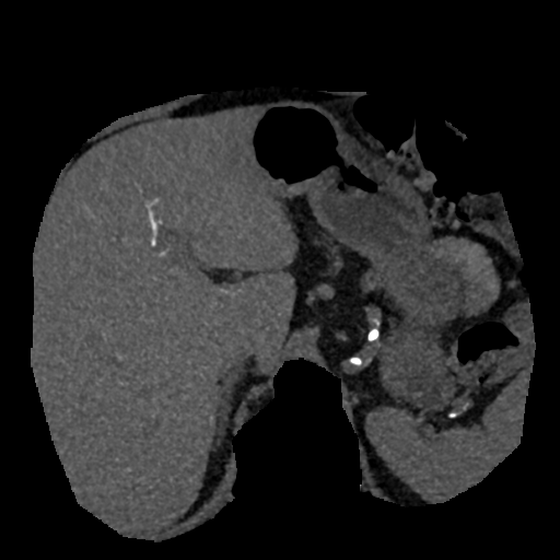 File:Normal CT intravenous cholangiogram (Radiopaedia 38199-40208 Axial IVC (MIP) 63).png