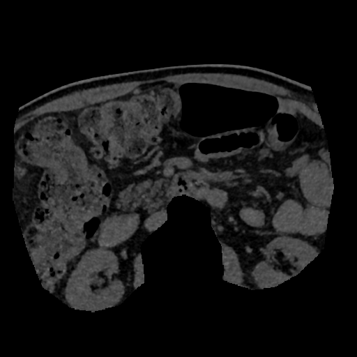 File:Normal CT intravenous cholangiogram (Radiopaedia 38199-40208 Axial IVC (MIP) 7).png