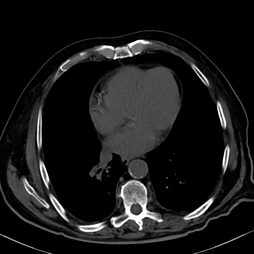 File:Normal CT intravenous cholangiogram (Radiopaedia 38199-40208 Axial IVC 3).png