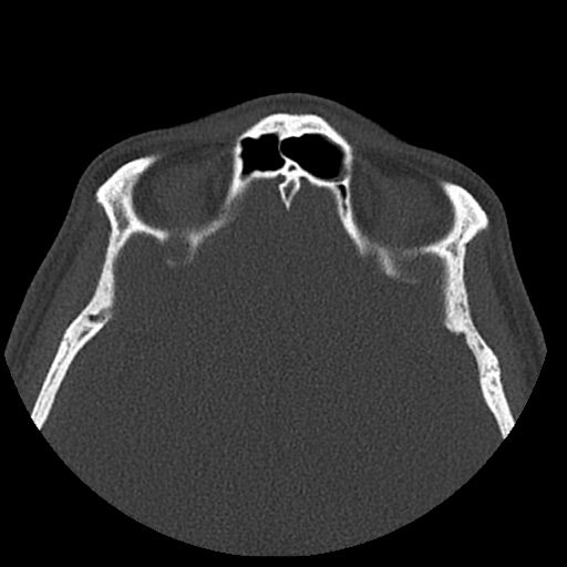 Normal CT paranasal sinuses (Radiopaedia 42286-45390 Axial bone window 31).jpg