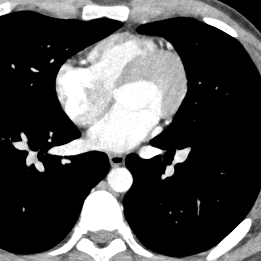 File:Normal CT pulmonary veins (pre RF ablation) (Radiopaedia 41748-44702 A 184).png