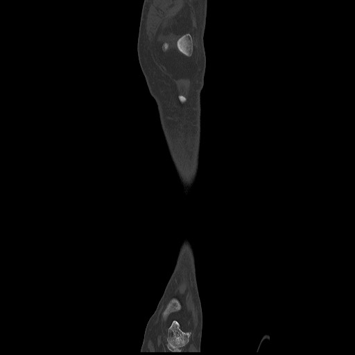 Normal CT tibia and fibula (Radiopaedia 51195-56848 Coronal non-contrast 21).jpg