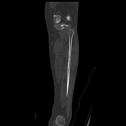 Normal CT tibia and fibula (Radiopaedia 51195-56848 Coronal non-contrast 45).jpg