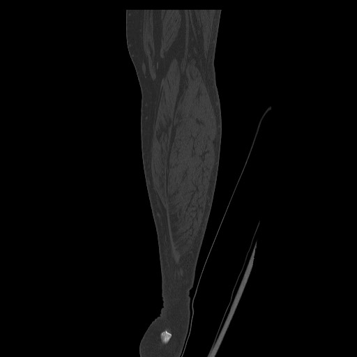 Normal CT tibia and fibula (Radiopaedia 51195-56848 Coronal non-contrast 59).jpg