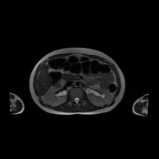 File:Normal MRI abdomen in pregnancy (Radiopaedia 88001-104541 Axial T2 23).jpg