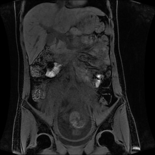 Normal MRI abdomen in pregnancy (Radiopaedia 88001-104541 M 69).jpg