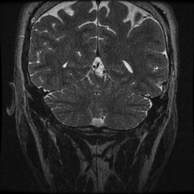 Normal MRI petrous (Radiopaedia 91317-108949 Coronal T2 117).jpg