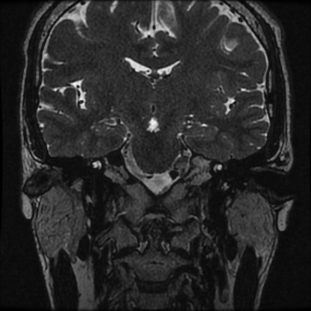 Normal MRI petrous (Radiopaedia 91317-108949 Coronal T2 36).jpg