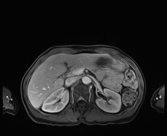 Normal adrenal glands MRI (Radiopaedia 82017-96004 K 32).jpg