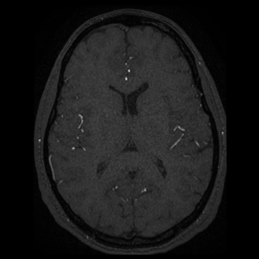 Normal brain MRA (Radiopaedia 41046-43793 Axial MRA 11).png