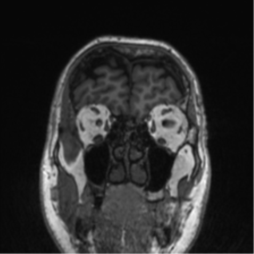 Normal brain MRI (non-focal epilepsy protocol) (Radiopaedia 53917-60040 Coronal T1 56).png