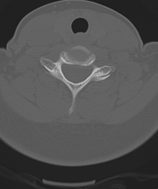 Normal cervical spine MRI (including Dixon) (Radiopaedia 42762-45926 Axial bone window 42).png
