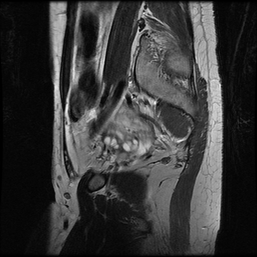 File:Normal female pelvis MRI (retroverted uterus) (Radiopaedia 61832-69933 Sagittal T2 26).jpg