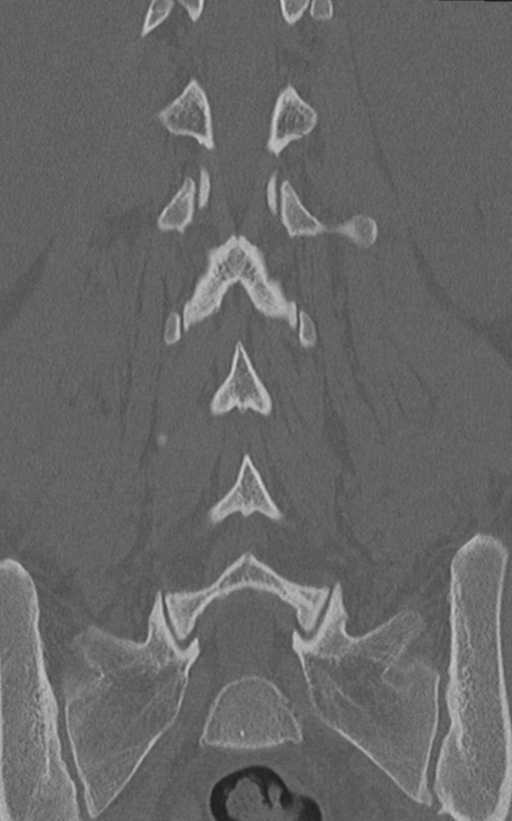 Normal lumbar spine CT (Radiopaedia 46533-50986 Coronal bone window 50).png