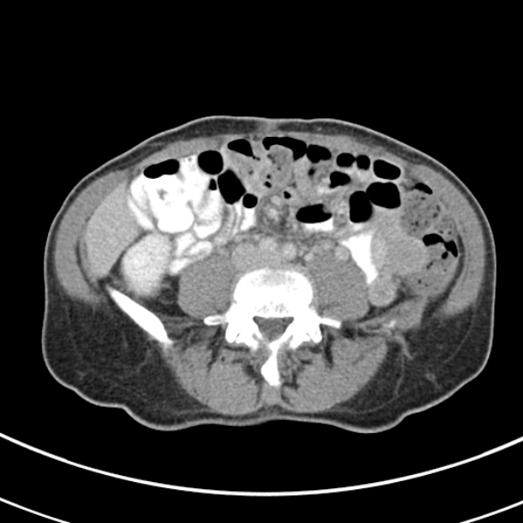 File:Normal multiphase CT liver (Radiopaedia 38026-39996 C 54).jpg