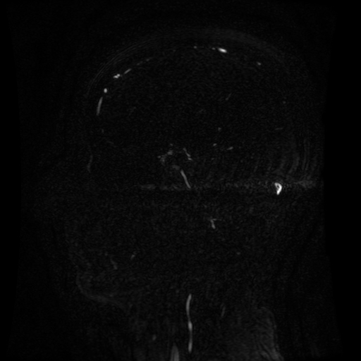 Normal noncontrast MR venography (Radiopaedia 87578-103957 A 72).jpg