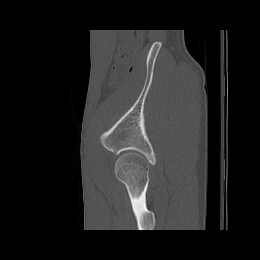 Normal pelvis (Radiopaedia 51473-57238 Sagittal bone window 120).jpg
