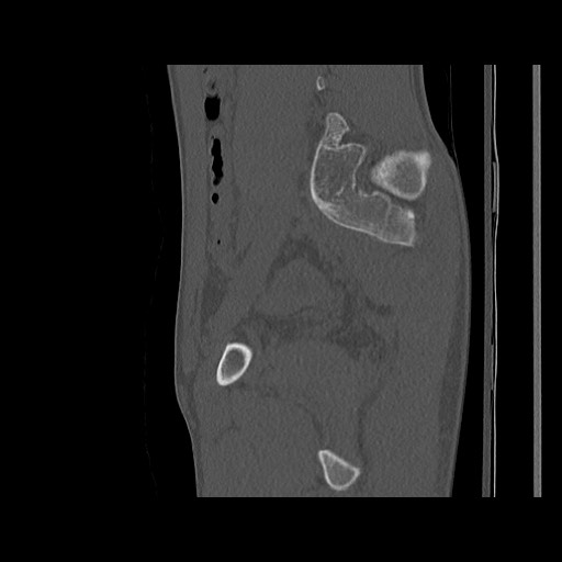 Normal pelvis (Radiopaedia 51473-57238 Sagittal bone window 97).jpg