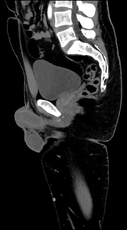 Normal pelvis CT angiogram (Radiopaedia 84966-100481 C 57).jpg