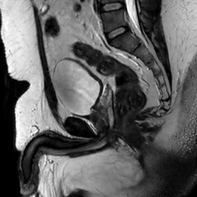 File:Normal prostate (MRI) (Radiopaedia 29986-30535 Sagittal T2 11).jpg