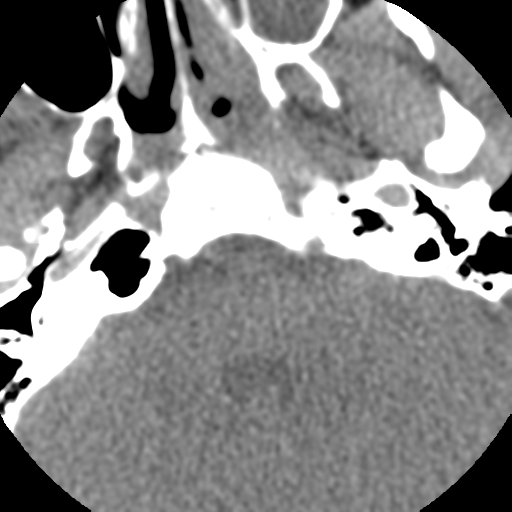 Normal trauma cervical spine (Radiopaedia 41017-43760 Axial non-contrast 2).png