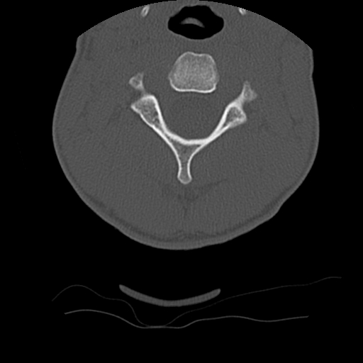 File:Normal trauma spine imaging (age 16) (Radiopaedia 45335-49358 Axial bone window 23).jpg
