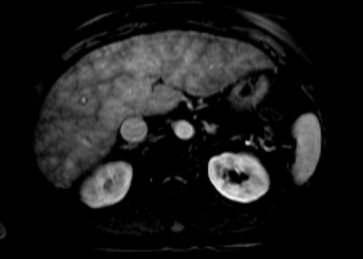 File:Nutmeg appearance of the liver (Radiopaedia 22879-22904 Axial T1 C+ 1).jpg