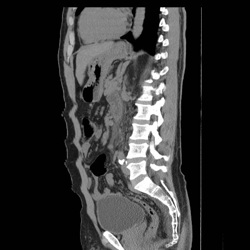 File:Obstructed kidney with perinephric urinoma (Radiopaedia 26889-27066 B 39).jpg