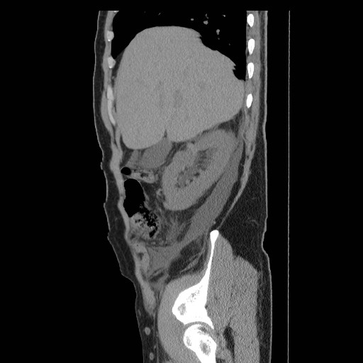 File:Obstructed kidney with perinephric urinoma (Radiopaedia 26889-27066 B 8).jpg