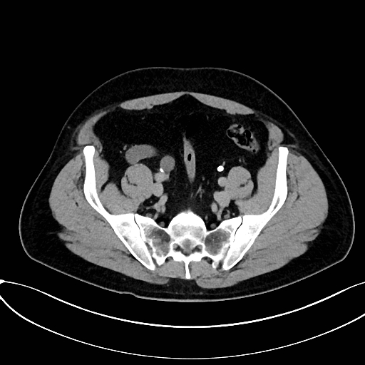 Obstructed upper pole ureter in a duplex kidney (Radiopaedia 54935-61221 Axial C+ delayed 82).jpg
