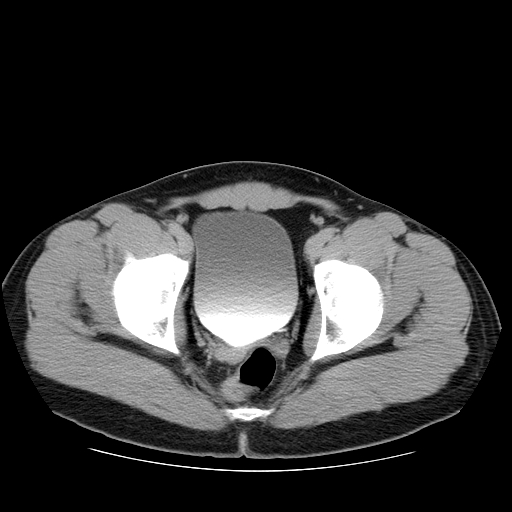 Obstructing ureteric calculus (Radiopaedia 18615-18514 D 52).jpg