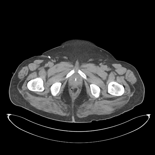 File:Obstructive pyelonephritis (Radiopaedia 46411-50844 Axial non-contrast 82).png